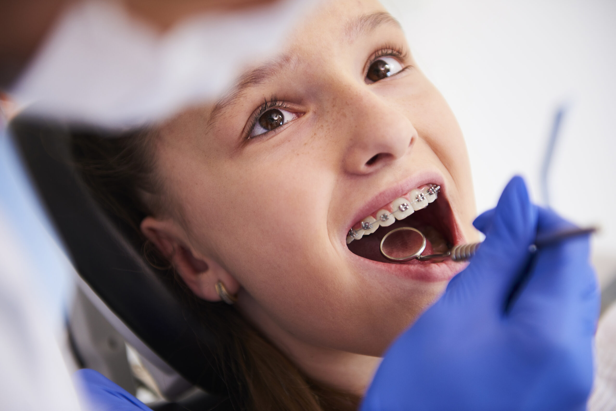 Minor Orthodontics in Hyderabad